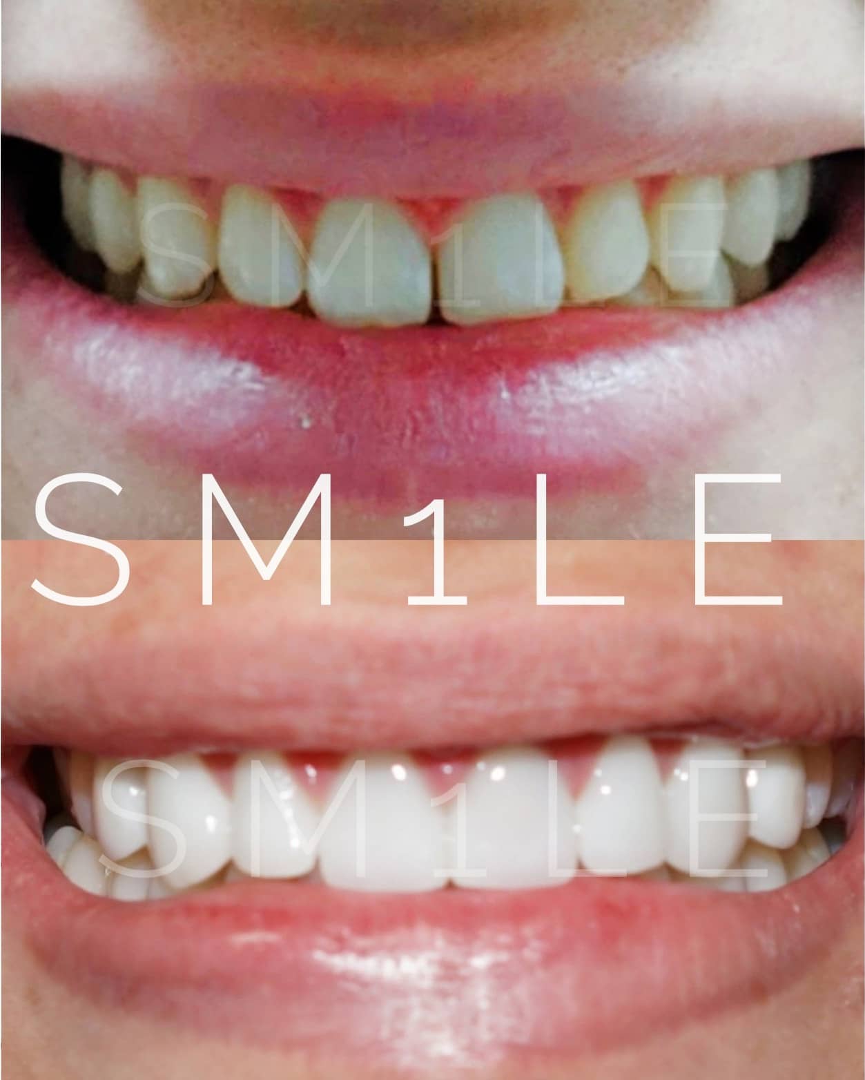 1Smile Dental | Night Guards, Ceramic Crowns and All-on-6