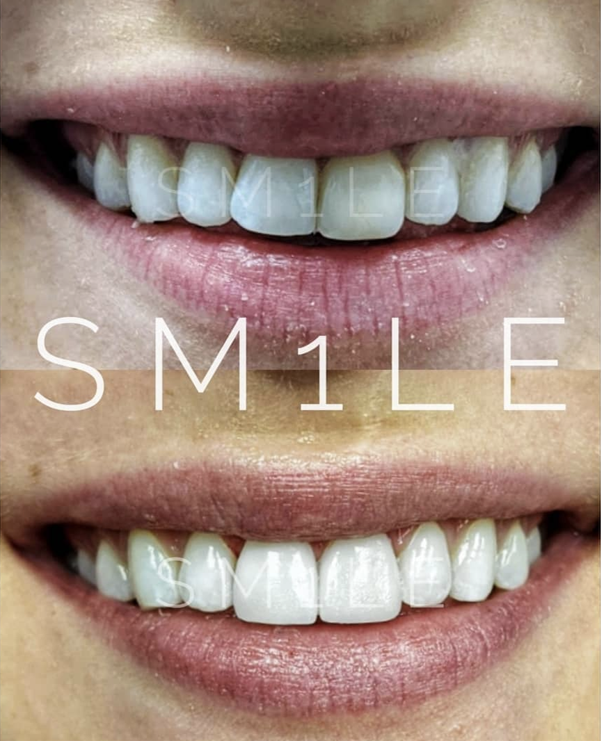 1Smile Dental | Braces, Teeth Whitening and VELscope® Cancer Screening